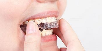 Frau setzt sich durchsichtige Zahnspange in den Mund