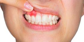 Nahaufnahme Mund mit Entzündung im Zahnfleisch