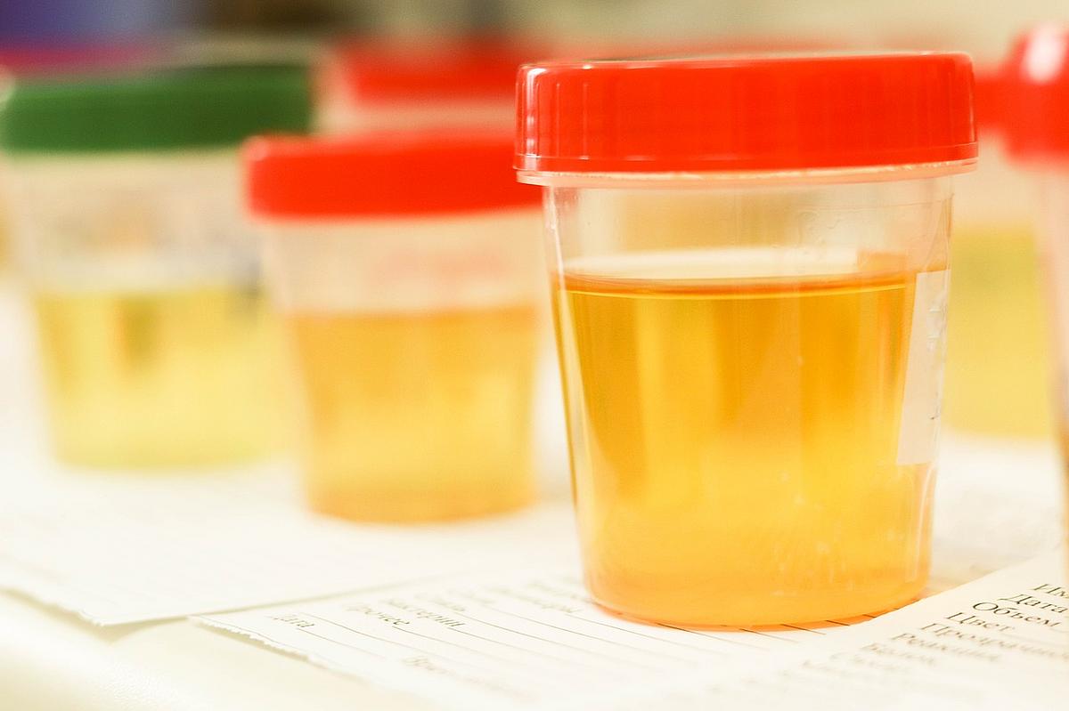 Auf dem Bild sind Urinproben in transparenten Becher in Nahaufnahme zu sehen.
