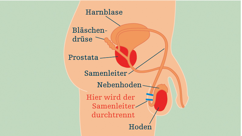 Grafik mit medizinischen Details des Mannes mit Samenleiter, Hoden und Nebenhoden, Prostata.